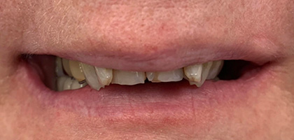 implantatbasiert-2